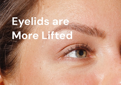 Eyelids are more lifted