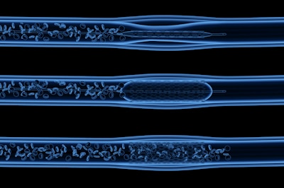 3d rendering x-ray balloon angioplasty procedure with stent in vein